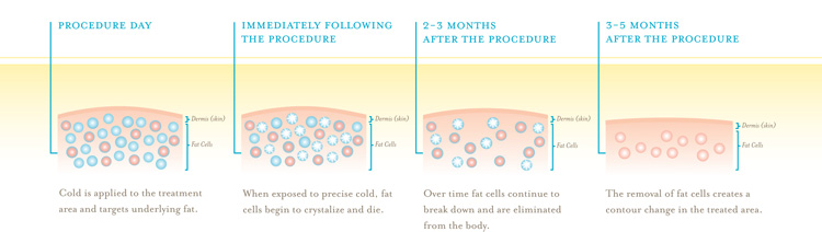 Cool Sculpting Illustration
