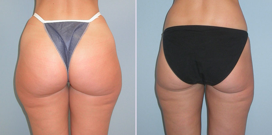 liposuction thighs and flanks