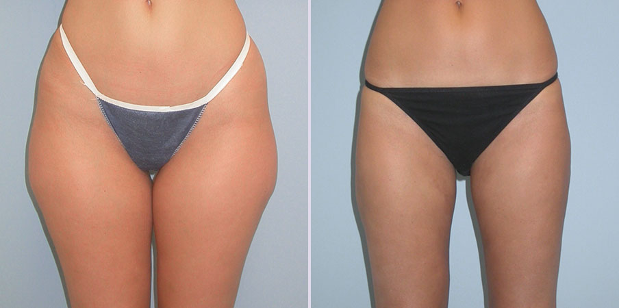 liposuction thighs and flanks