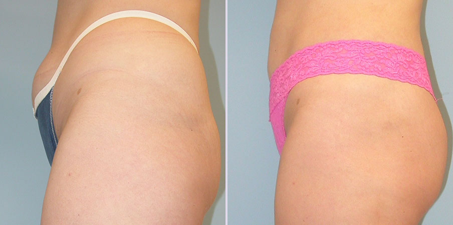 liposuction plastic surgery