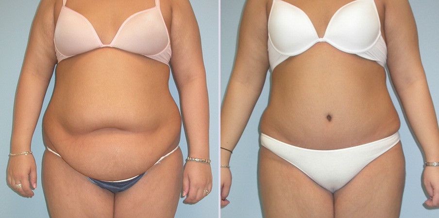 abdominoplasty