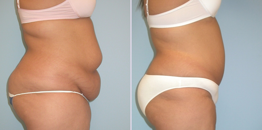 abdominoplasty