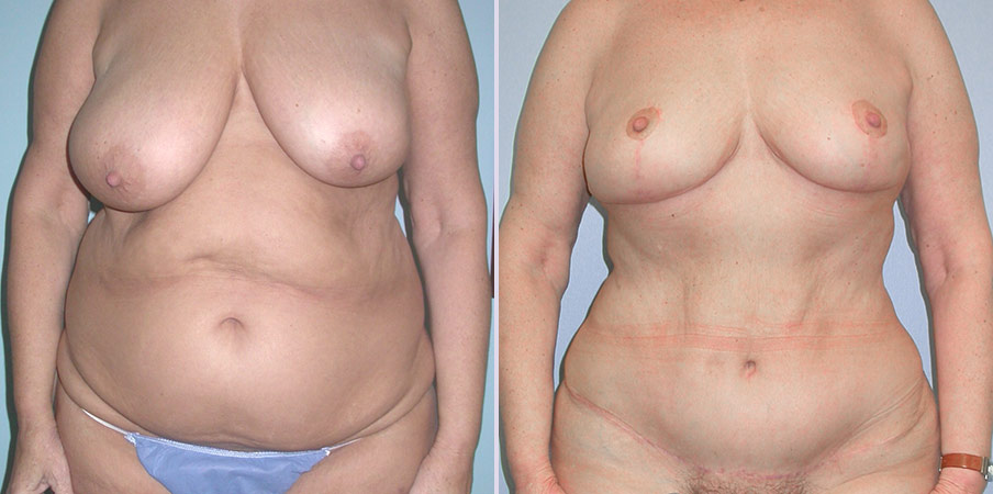 abdominoplasty plastic surgery