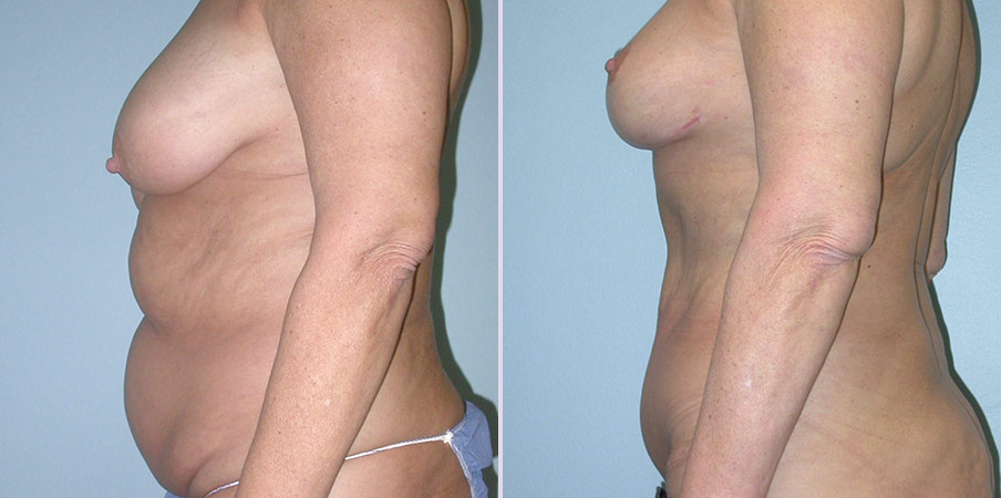abdominoplasty plastic surgery 
