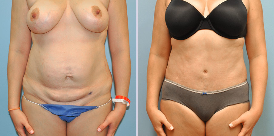 tummy tuck