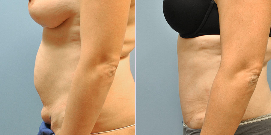 tummy tuck