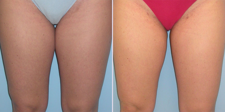 liposuction plastic surgery example
