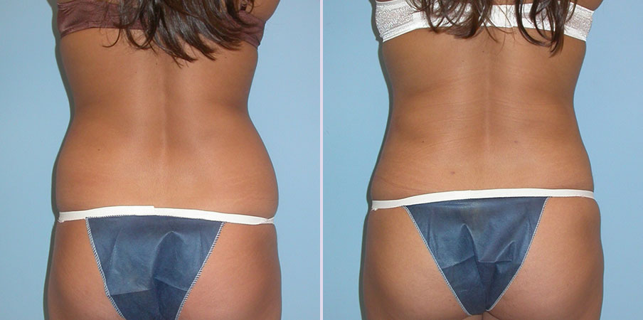 liposuction stomach hips flank back