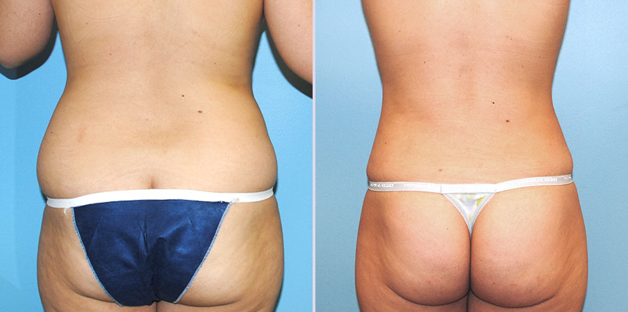 liposuction surgery back