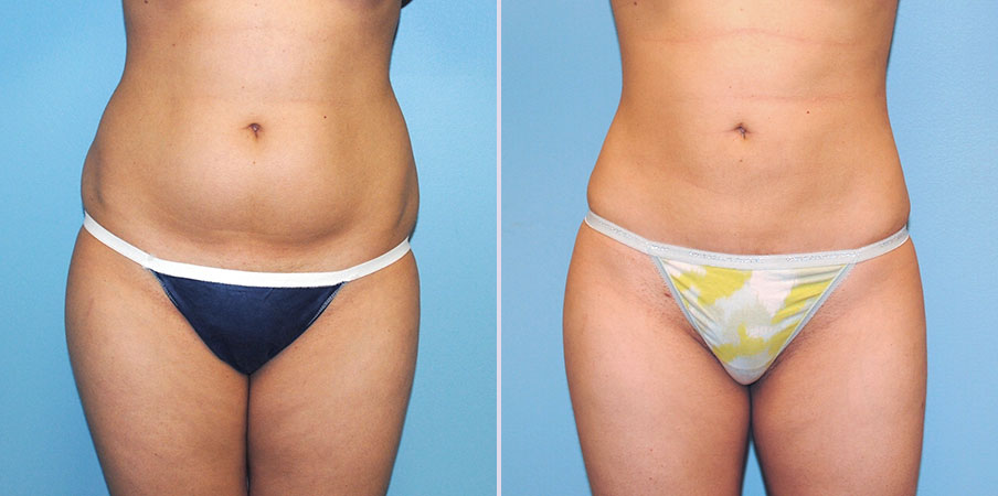 liposuction surgery