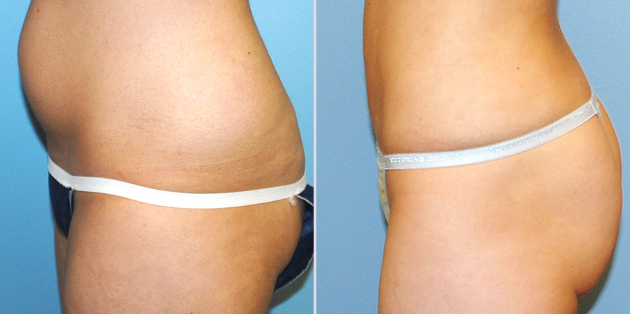 liposuction surgery left