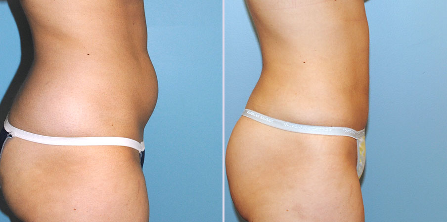 liposuction surgery right