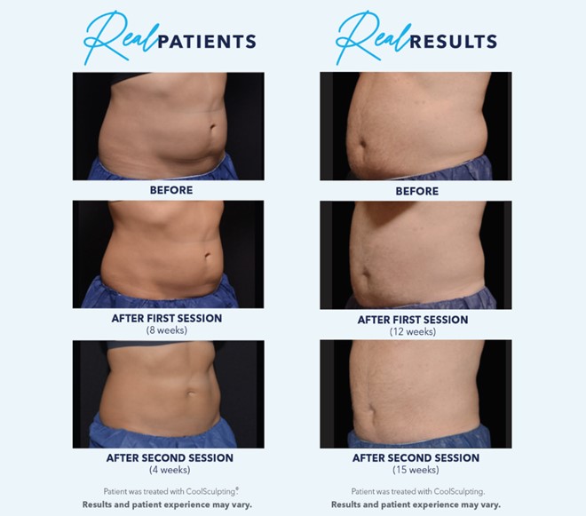 How Long Does Coolsculpting Last 