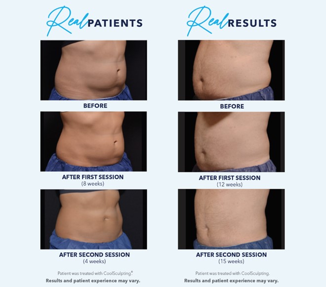 CoolSculpting vs. Liposuction - 3 Difference in the Procedures