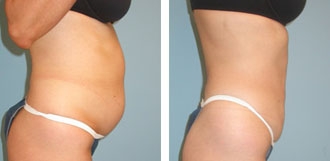 abdominoplasty1a