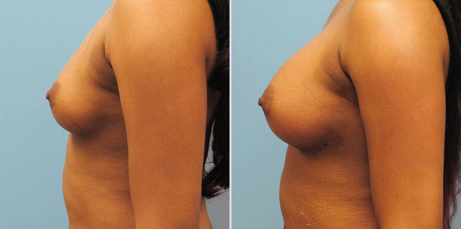 breast-augmentation-6side