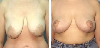 breast_lift1a