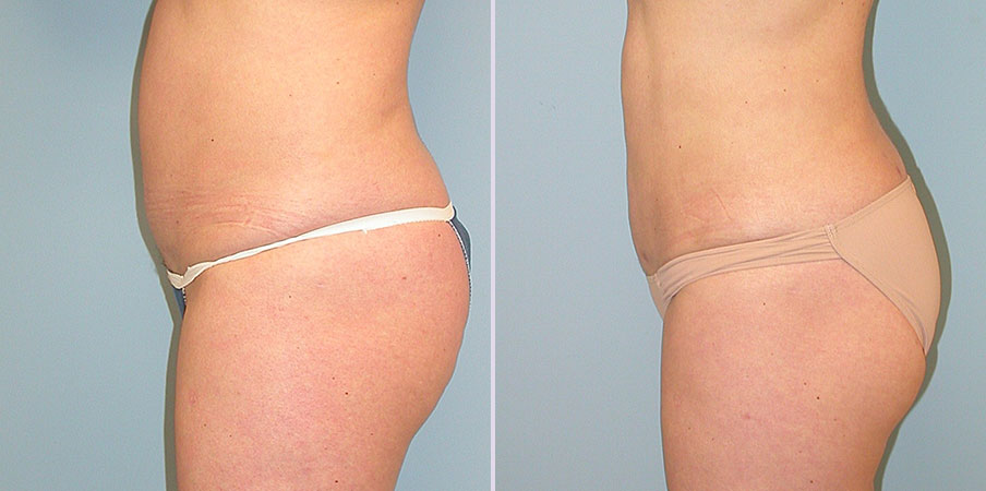 liposuction plastic surgery before and after