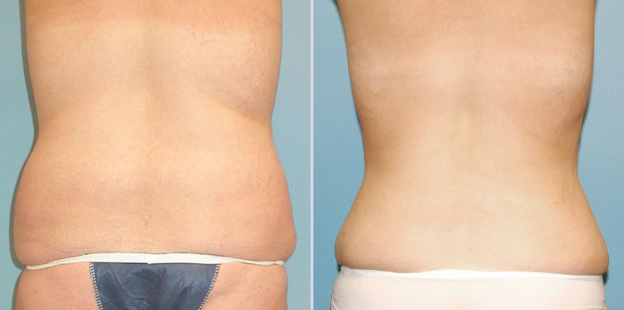 liposuction love handles